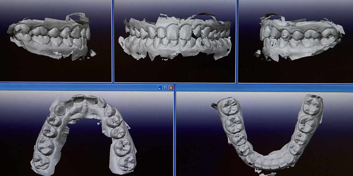 Image of Digital Impression Scans