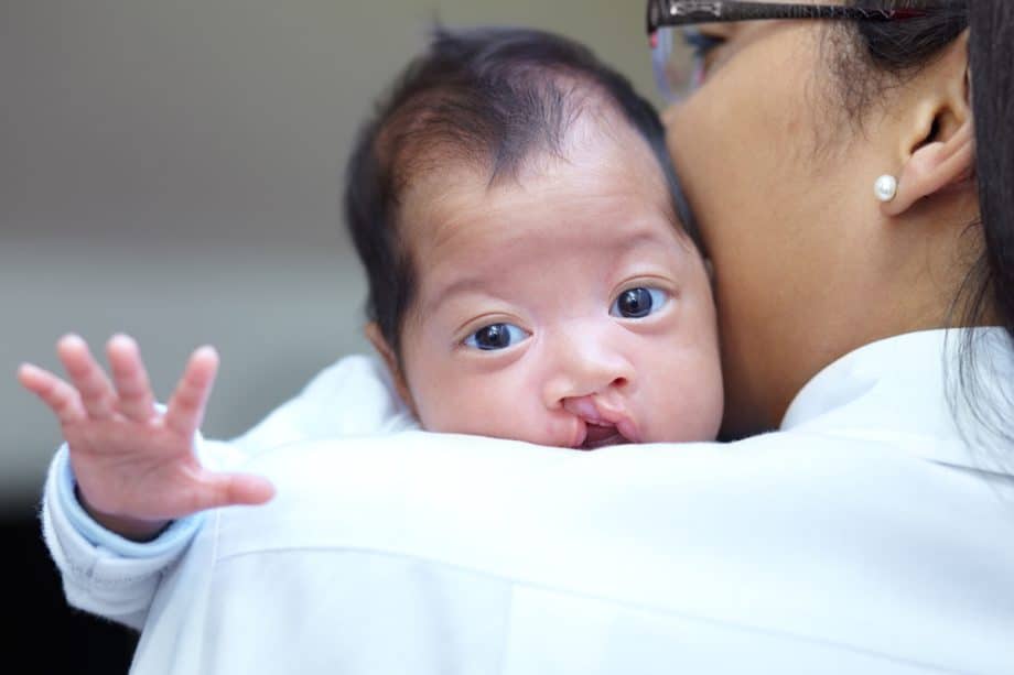 Can You Prevent Cleft Lip in Babies?