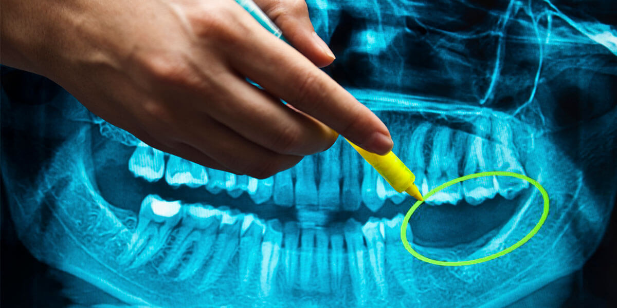 Xray of Dental Implant Image