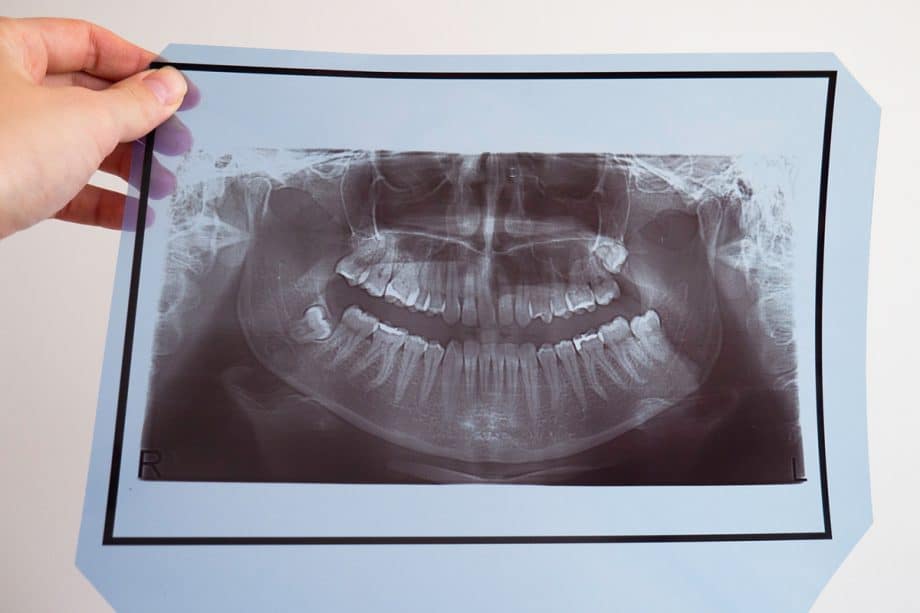 How Long Does Recovery Take After Orthognathic Surgery?