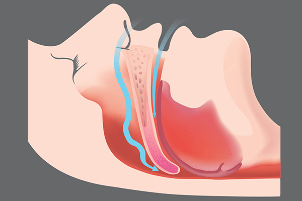 Graphic of an obstructed airway