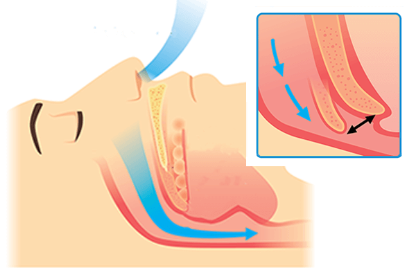 Graphic of Snoring example